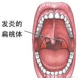 扁桃体（人体器官）