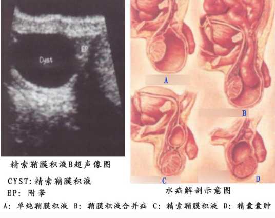 小儿睾丸鞘膜积液