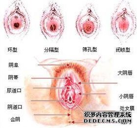 处女膜切开术