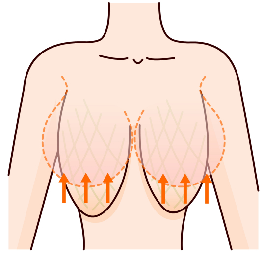 乳房下垂