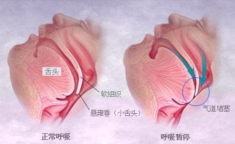 足球球员被撞后为什么会吞舌窒息