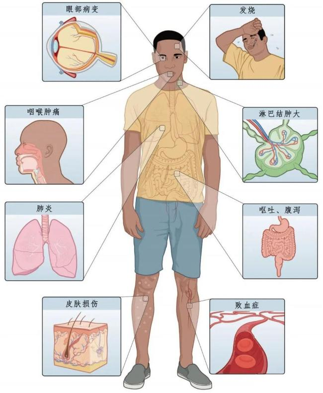 猴痘病毒会成为下一个“天花”吗？猴痘与天花有什么区别？