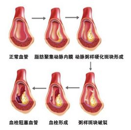 血栓溶解的作用机理