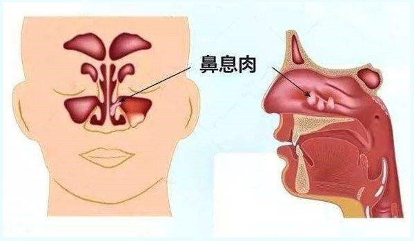 鼻子里有个小肉球