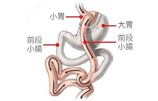 什么是减重手术？