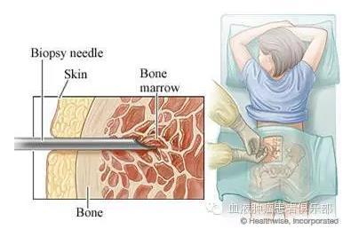 骨穿是检查什么的