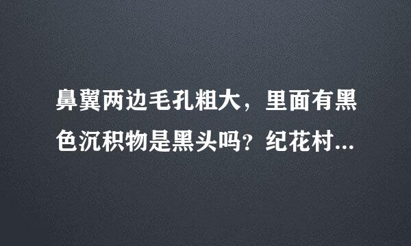 鼻翼两边毛孔粗大，里面有黑色沉积物是黑头吗？纪花村黑头终结套装效果怎么样？