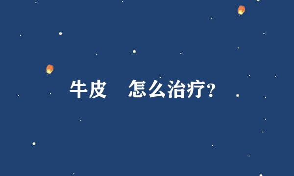 牛皮廯怎么治疗？