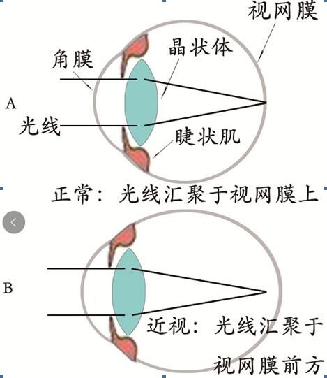 怎么让眼睛视力恢复