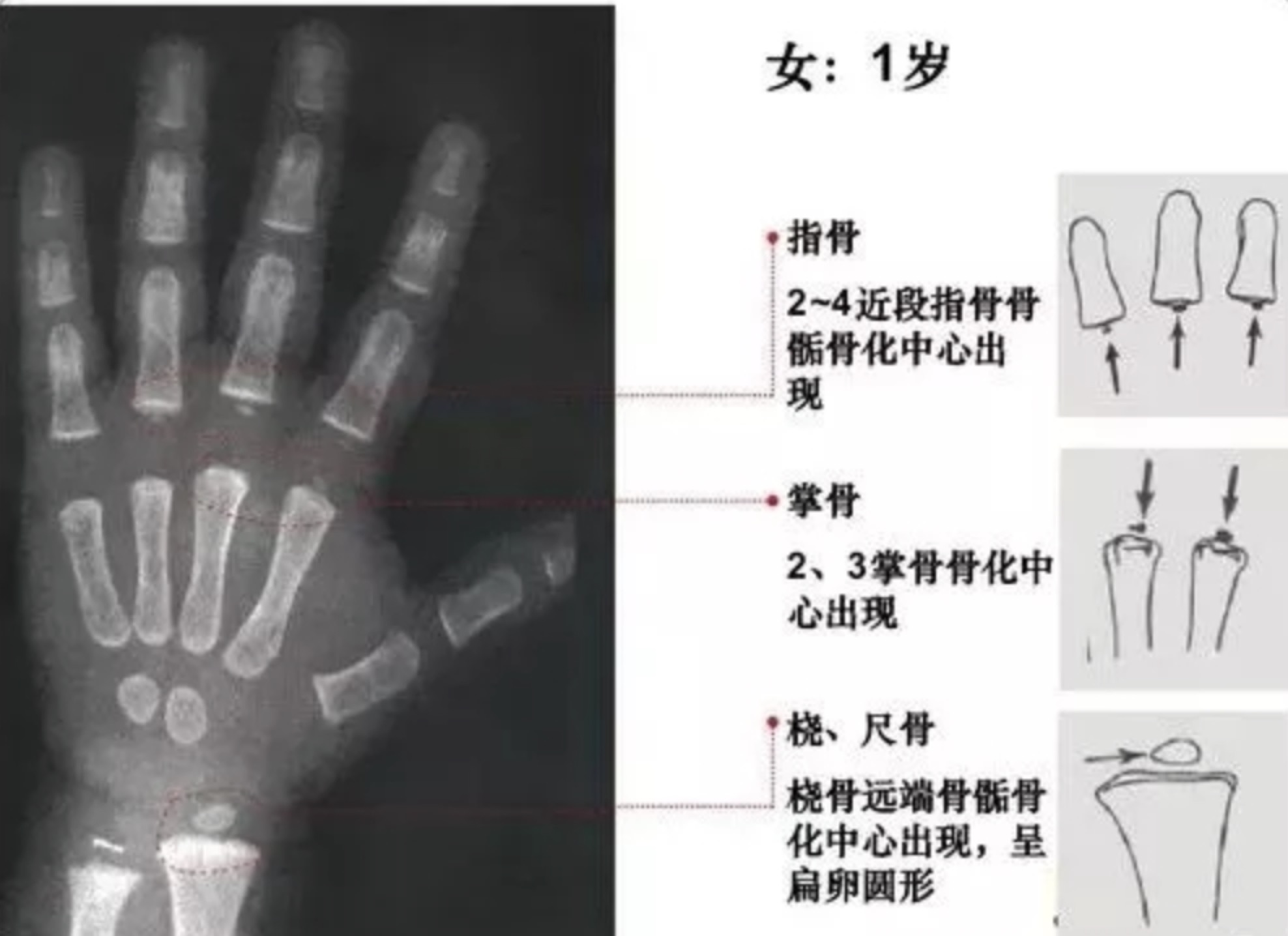 骨龄怎样计算？？