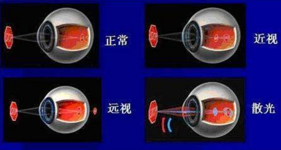 屈光不正是什么意思